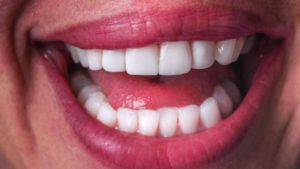 Uveneer: Simplifying Artistic Direct Composite Veneering - Dentistry Today
